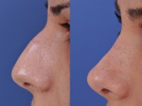 before and after rhinoplasty left side closeup view female patient case 4978