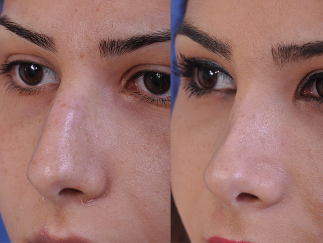 before and after rhinoplasty left angle closeup view female patient case 4978