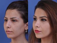 before and after rhinoplasty left angle view female patient case 4978