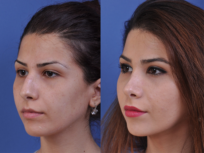 before and after rhinoplasty left angle view female patient case 4978