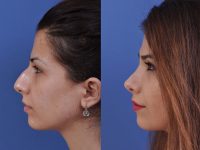 before and after rhinoplasty left side view female patient case 4978