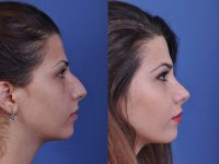before and after rhinoplasty right side view female patient case 4978