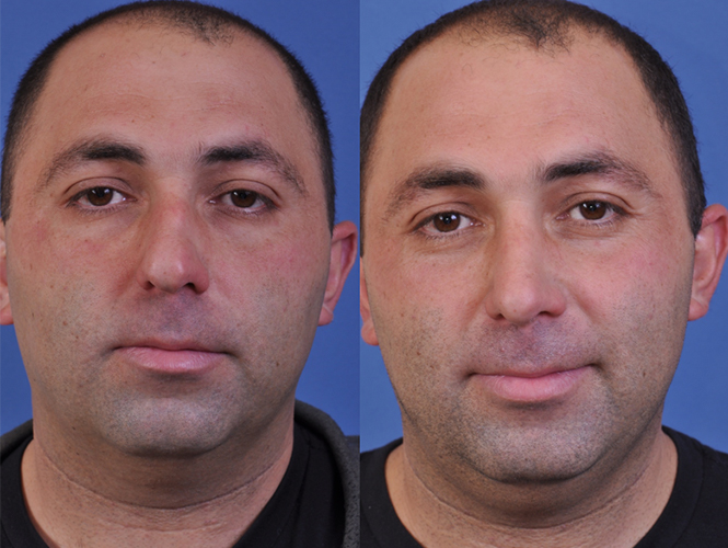 before and after rhinoplasty front view male patient case 4987