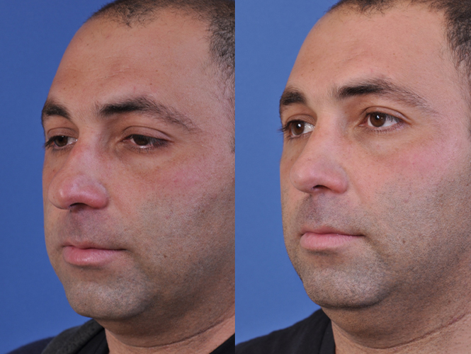 before and after rhinoplasty left angle view male patient case 4987