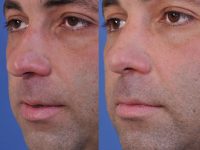 before and after rhinoplasty left angle closeup view male patient case 4987