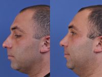 before and after rhinoplasty left side view male patient case 4987