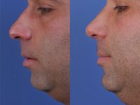 before and after rhinoplasty left side view male patient case 4987