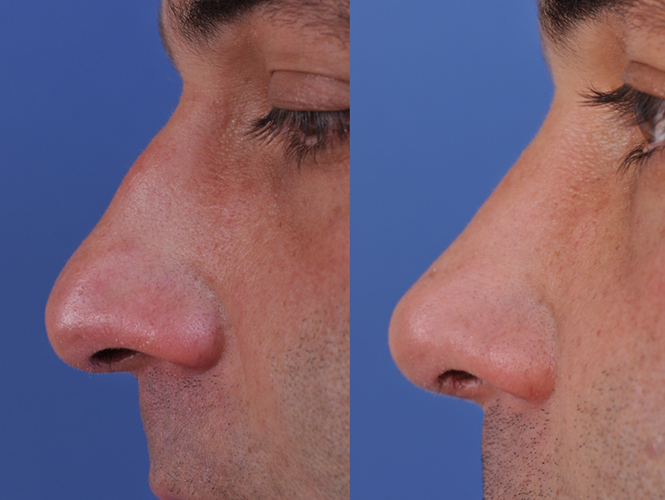 before and after rhinoplasty left side closeup view male patient case 4987