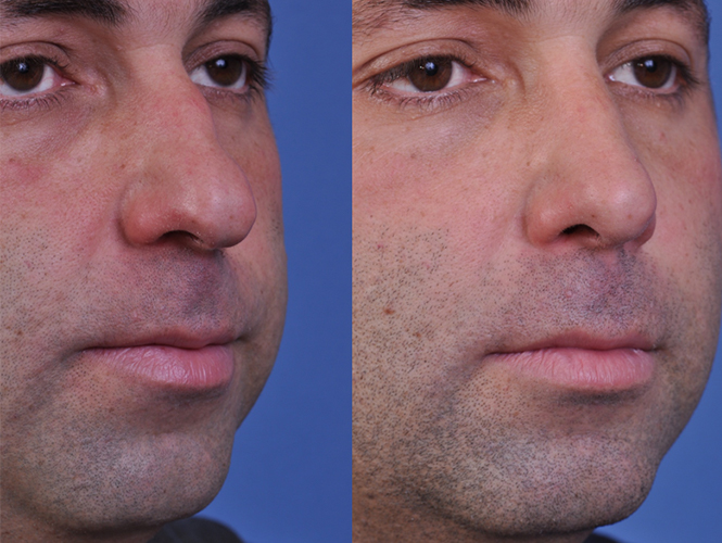 before and after rhinoplasty right angle view male patient case 4987