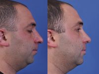 before and after rhinoplasty right side view male patient case 4987