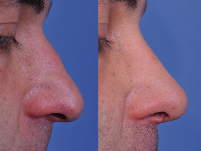 before and after rhinoplasty right side closeup view male patient case 4987