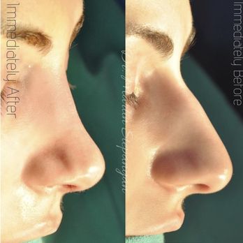before and after rhinoplasty side view female patient Glendale, CA