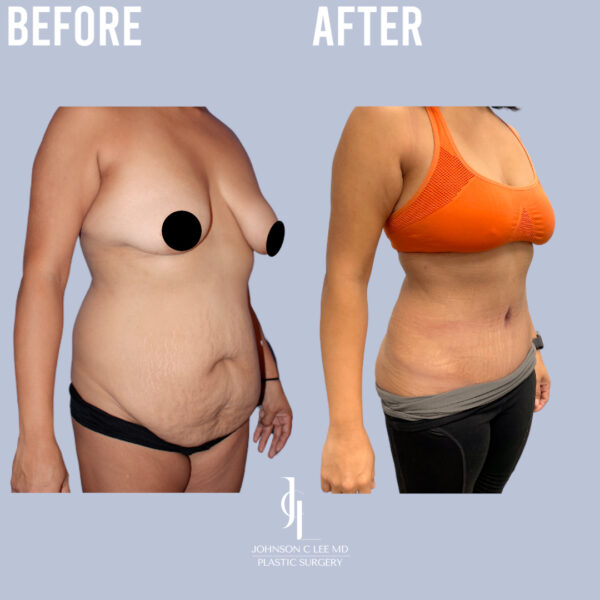 Tummy Tuck Liposuction