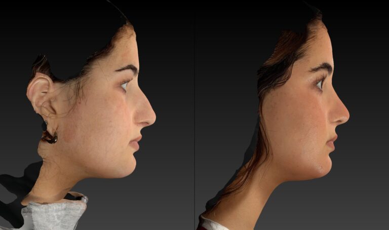 Before and after of rhinoplasty right view side of female patient 6787